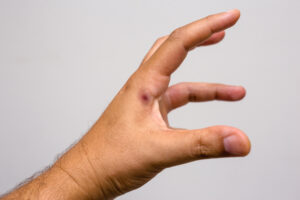 Bark Scorpion sting on man’s hand